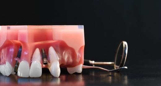 השתלות שיניים עם שיקום מיידי